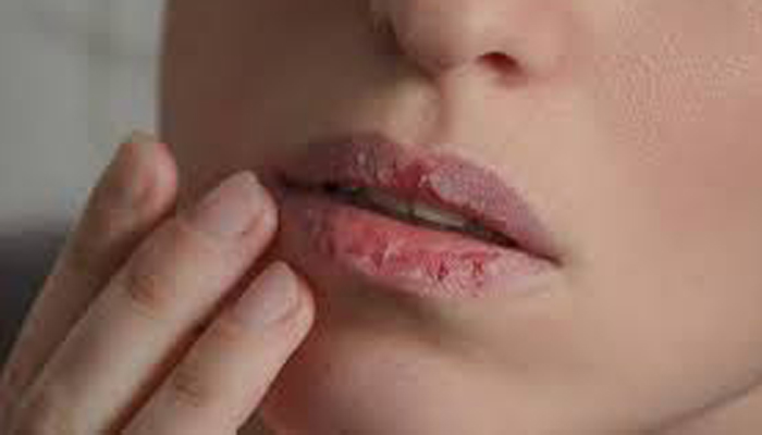 শীতে ঠোঁট ও মুখে ঘা হলে যেভাবে মিলবে সমাধান