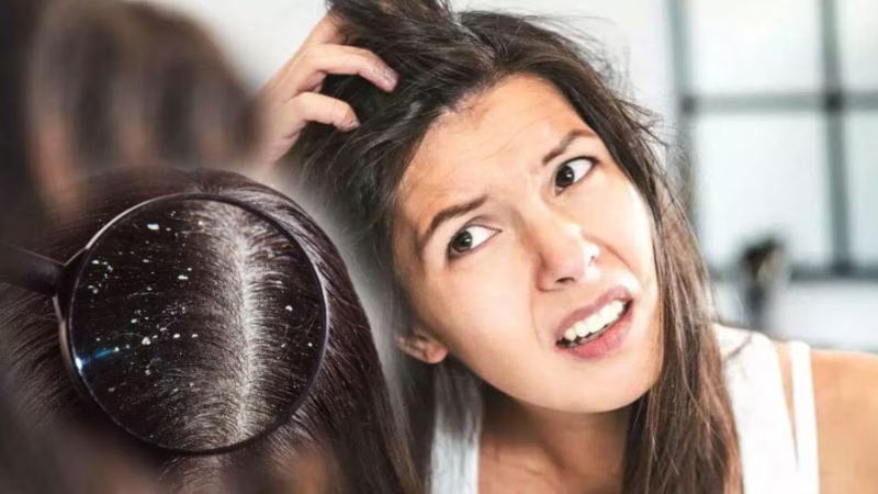 শীতকালে খুশকি দূর করার সহজ ও কার্যকর উপায়