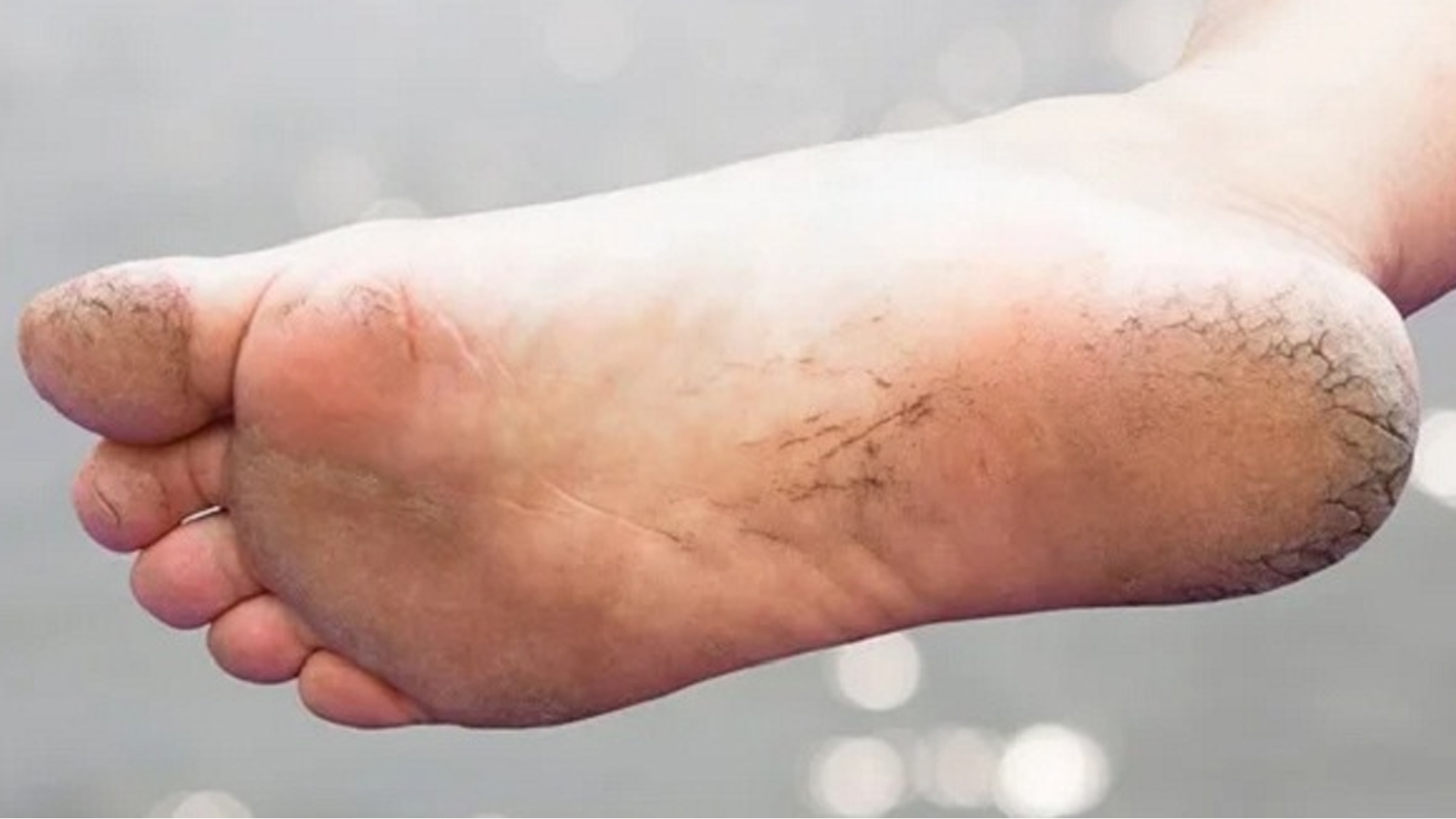 শীতে পা ফাটা রোধ করবেন যেভাবে