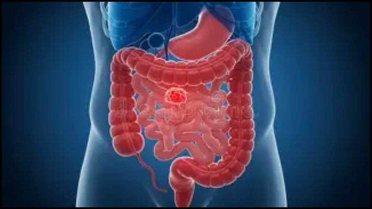 বর্তমানে ক্যানসারজনিত মৃত্যুর প্রধান কারণ কোলোরেক্টাল ক্যানসার