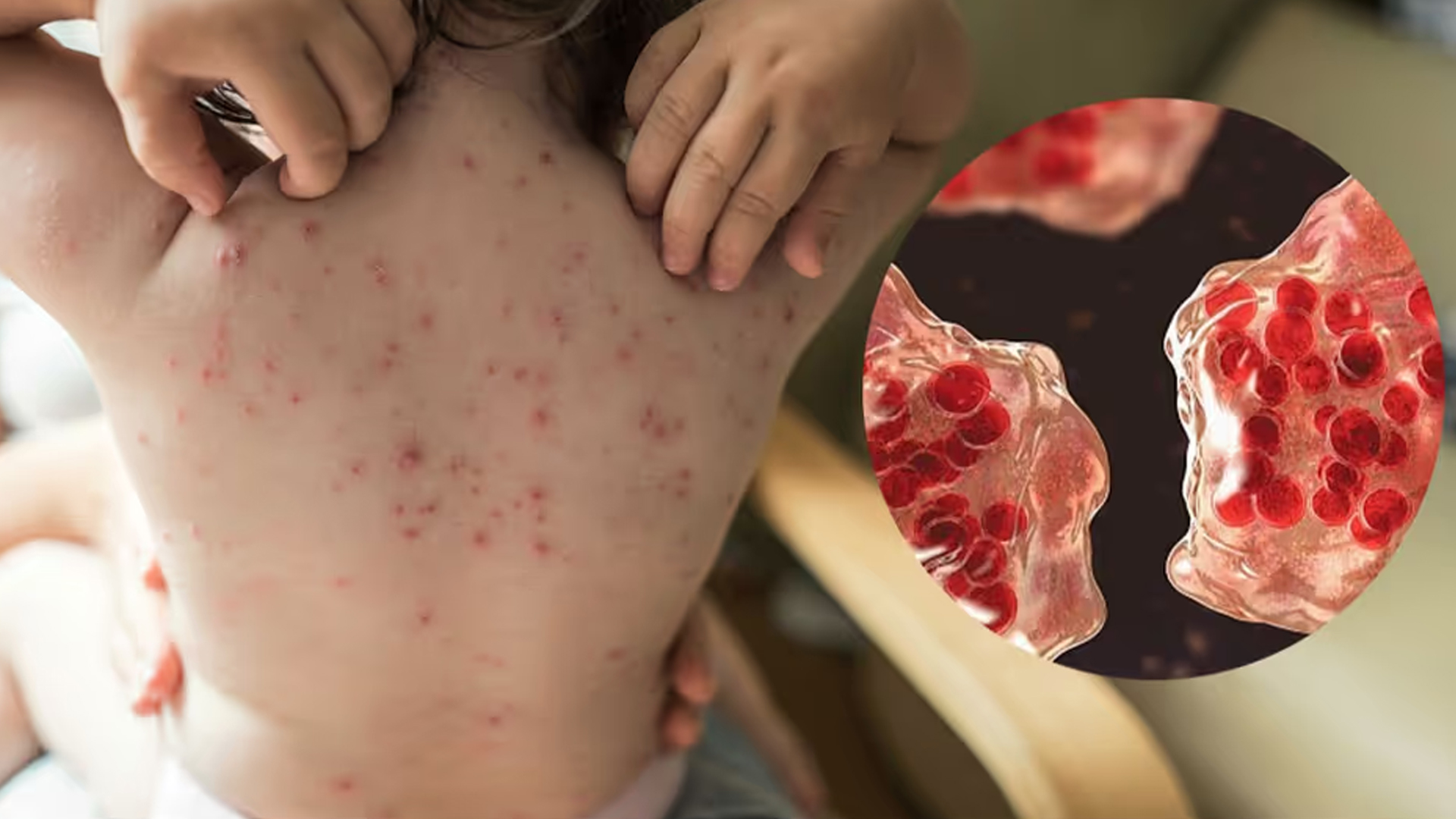 হাম হলে কী খেতে হবে?