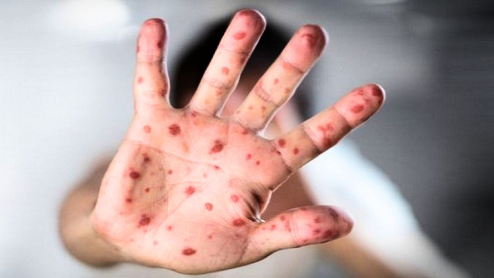 হামের প্রাদুর্ভাব নিয়ে ভয়ংকর তথ্য!