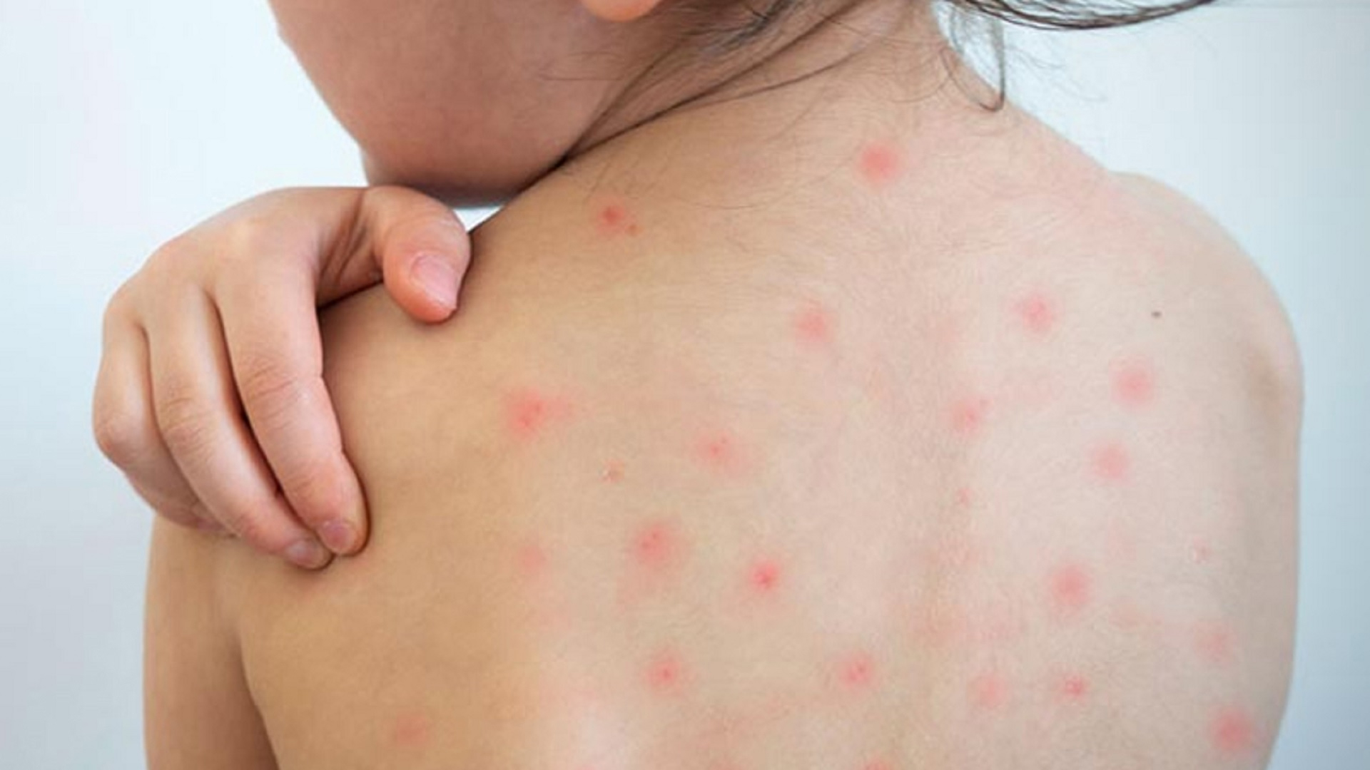 ২৪ ঘণ্টায় হামে আক্রান্ত ২৬, সন্দেহজনক মৃত্যু ৪